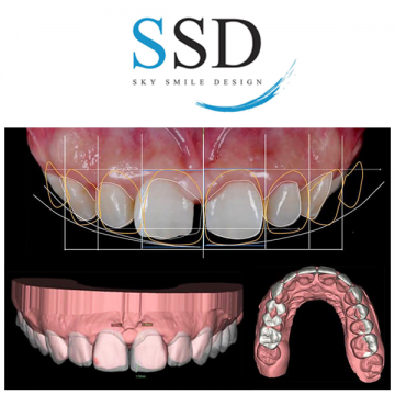 SSD-Sky-Smile-Design-Skydental-3D